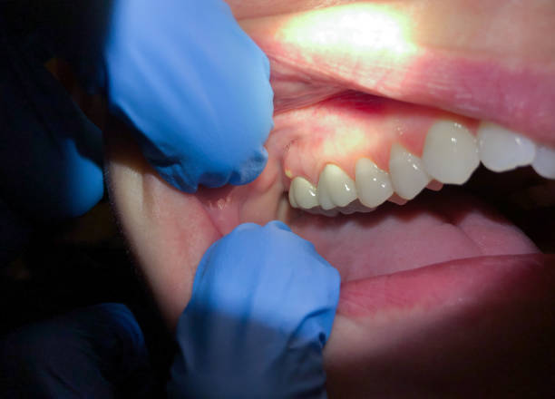 Best Emergency Denture Repair in Morehead, KY